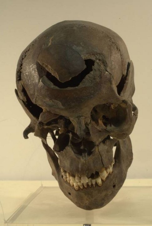 Front of the Skull of Stanwick Man