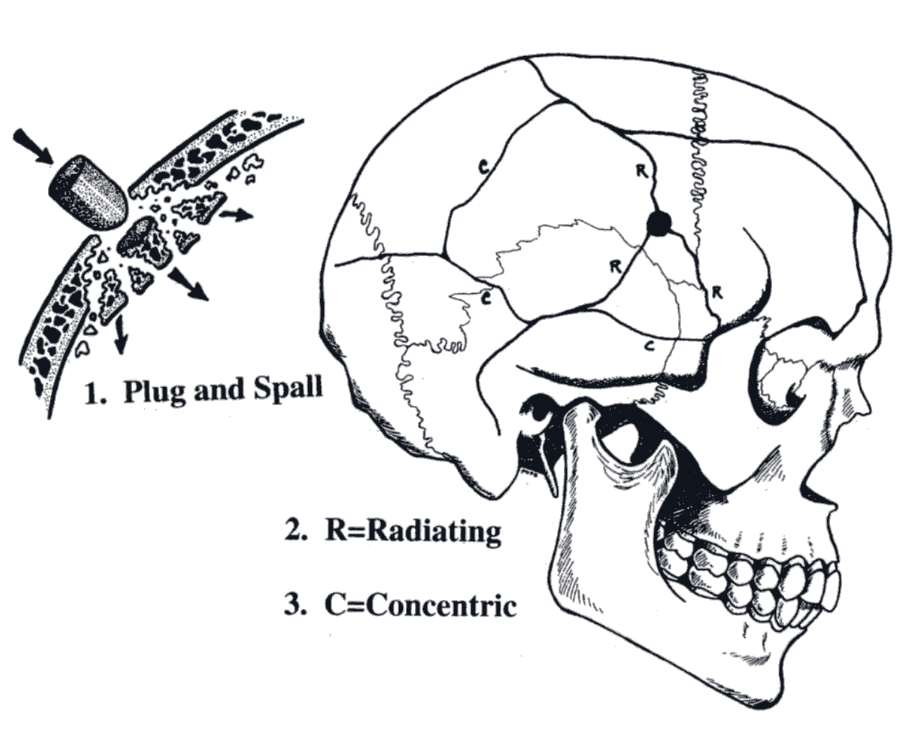 Damage to skull sustained by a direct bullet strike.
